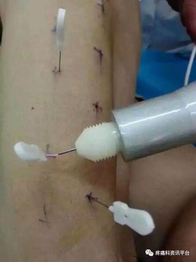 高频治疗仪治什么病高频电火花水针治疗仪的治疗原理及应用_https://www.jmylbn.com_新闻资讯_第4张