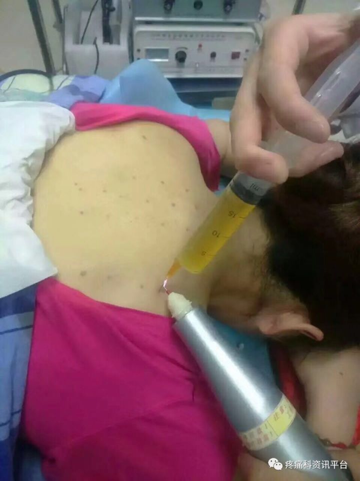 高频治疗仪治什么病高频电火花水针治疗仪的治疗原理及应用_https://www.jmylbn.com_新闻资讯_第3张