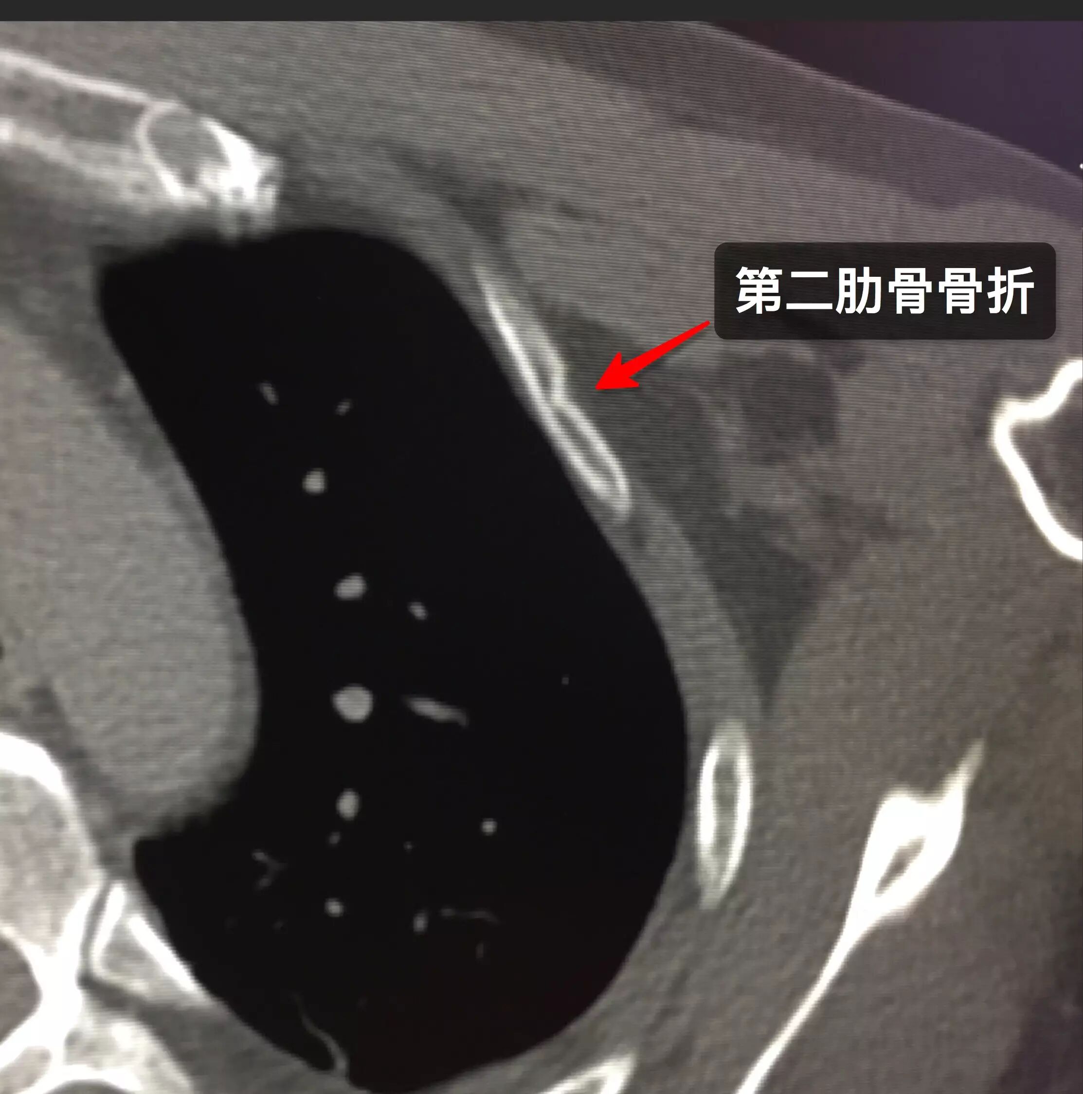 那些年 你漏診過的肋骨骨折 醫學界影像診斷與介入頻道 微文庫
