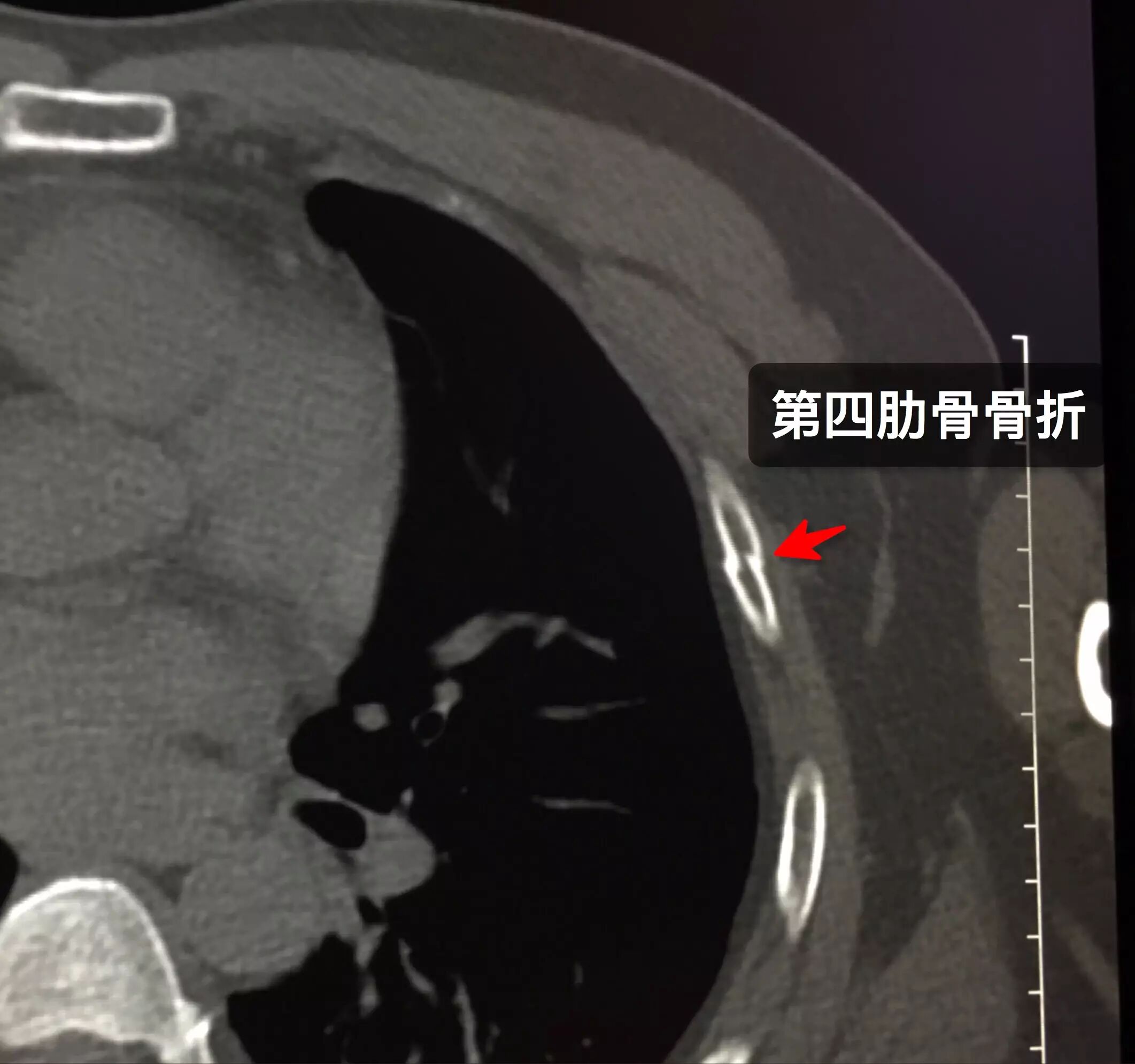 那些年 你漏診過的肋骨骨折 醫學界影像診斷與介入頻道 微文庫