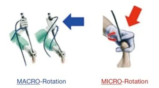 输尿管鞘是什么输尿管软镜碎石术_https://www.jmylbn.com_新闻资讯_第11张