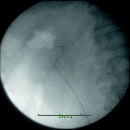 输尿管鞘是什么输尿管软镜为何需要辅助输尿管输送鞘 (UAS) ？_https://www.jmylbn.com_新闻资讯_第3张