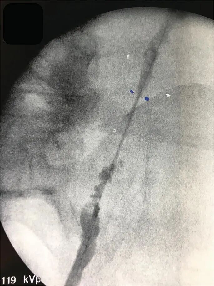 输尿管鞘是什么输尿管软镜碎石术_https://www.jmylbn.com_新闻资讯_第22张