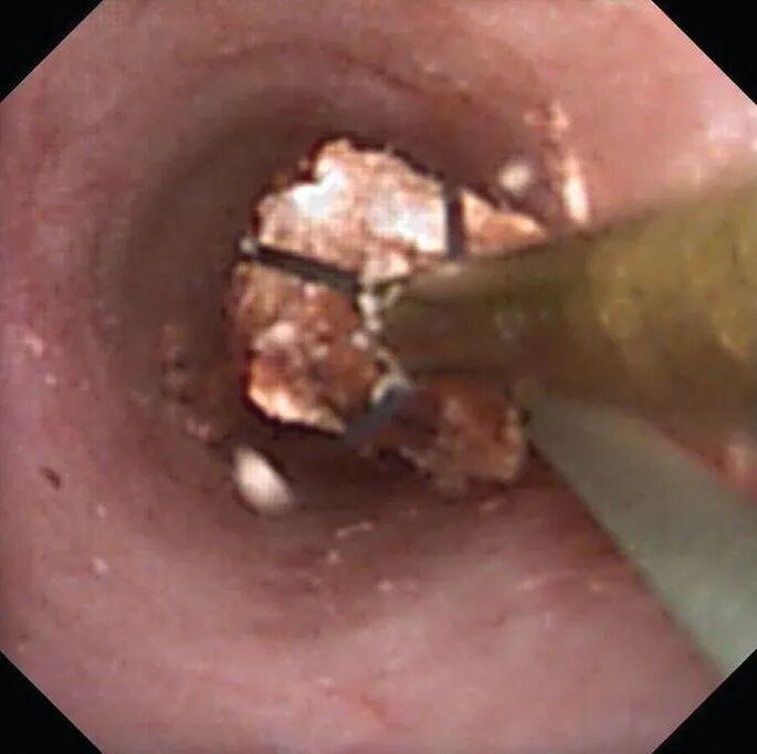 输尿管鞘是什么输尿管软镜碎石术_https://www.jmylbn.com_新闻资讯_第21张