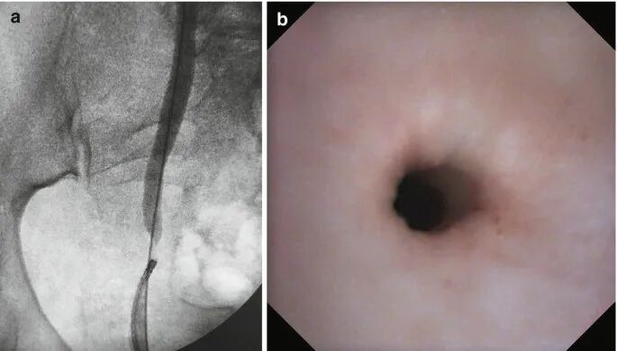 输尿管鞘是什么输尿管软镜碎石术_https://www.jmylbn.com_新闻资讯_第24张