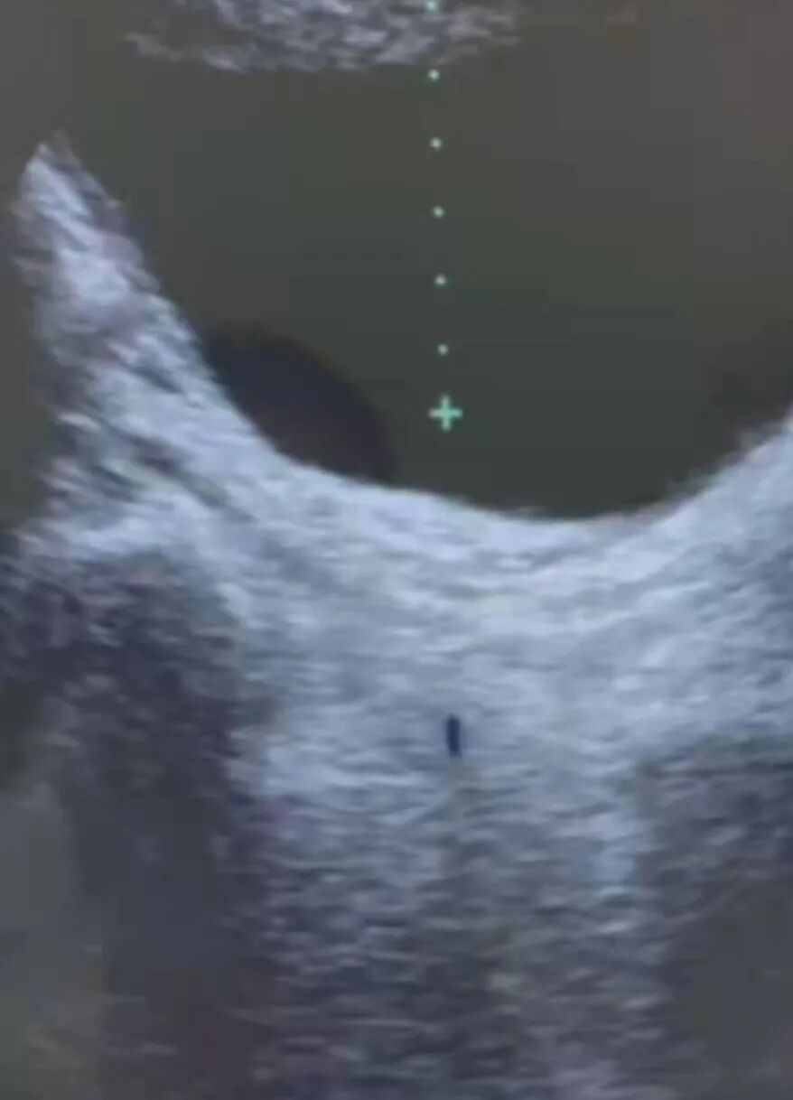 体外碎石b超怎么定位输尿管下段结石（壁间段结石）体外冲击波碎石要点_https://www.jmylbn.com_新闻资讯_第5张