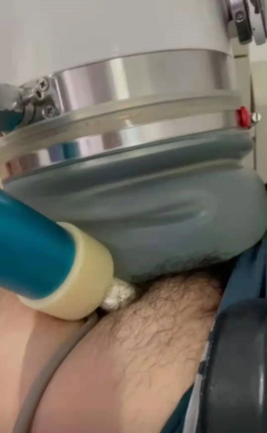 体外碎石b超怎么定位输尿管下段结石（壁间段结石）体外冲击波碎石要点_https://www.jmylbn.com_新闻资讯_第8张