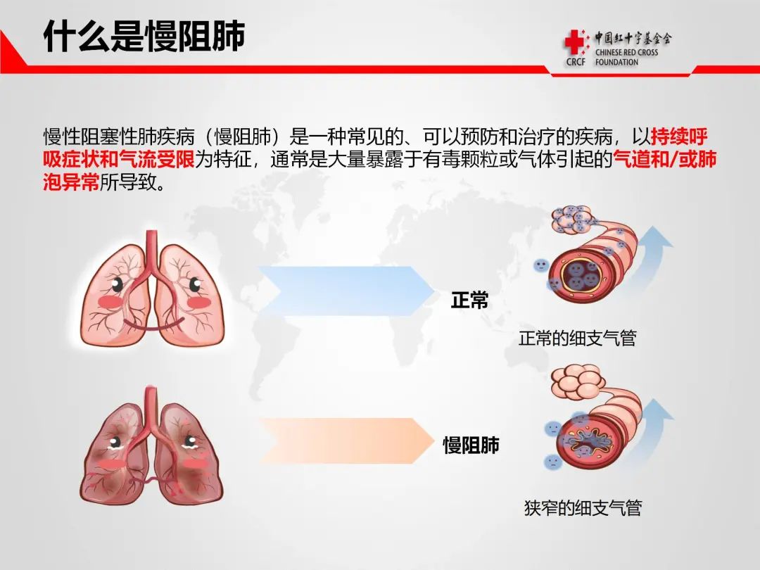 科普讲座 | 慢性阻塞性肺病的预防与护理 - 【第四十三场】