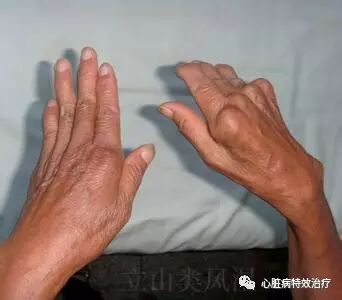 贝诺酯 普鲁卡因青霉素,3种方案根据病情轻重,第一种用于病情比较轻者