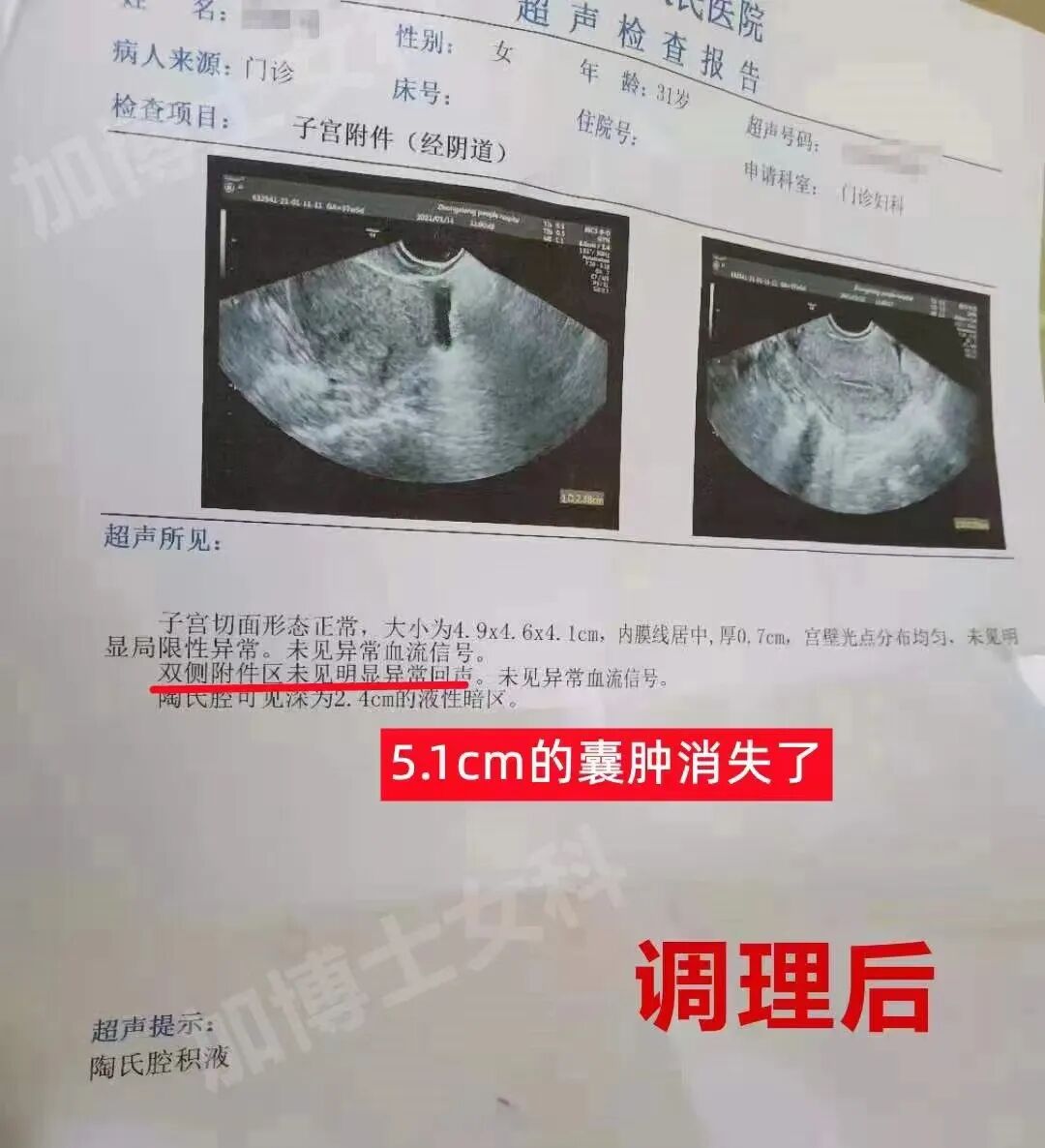 肌瘤钻怎么写术后4年肌瘤再复发，肌瘤竟像爬山虎一样“钻”进了心脏…_https://www.jmylbn.com_新闻资讯_第10张