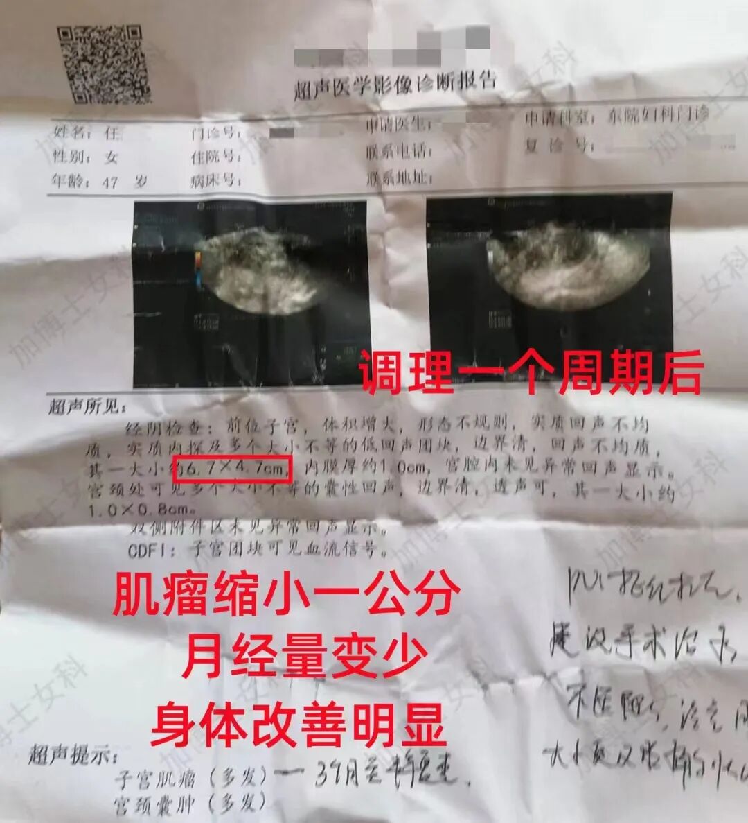 肌瘤钻怎么写术后4年肌瘤再复发，肌瘤竟像爬山虎一样“钻”进了心脏…_https://www.jmylbn.com_新闻资讯_第6张