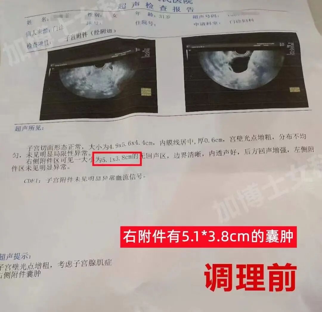 肌瘤钻怎么写术后4年肌瘤再复发，肌瘤竟像爬山虎一样“钻”进了心脏…_https://www.jmylbn.com_新闻资讯_第9张