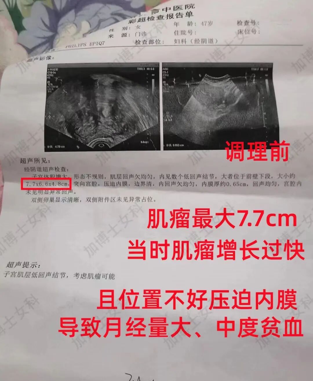 肌瘤钻怎么写术后4年肌瘤再复发，肌瘤竟像爬山虎一样“钻”进了心脏…_https://www.jmylbn.com_新闻资讯_第5张