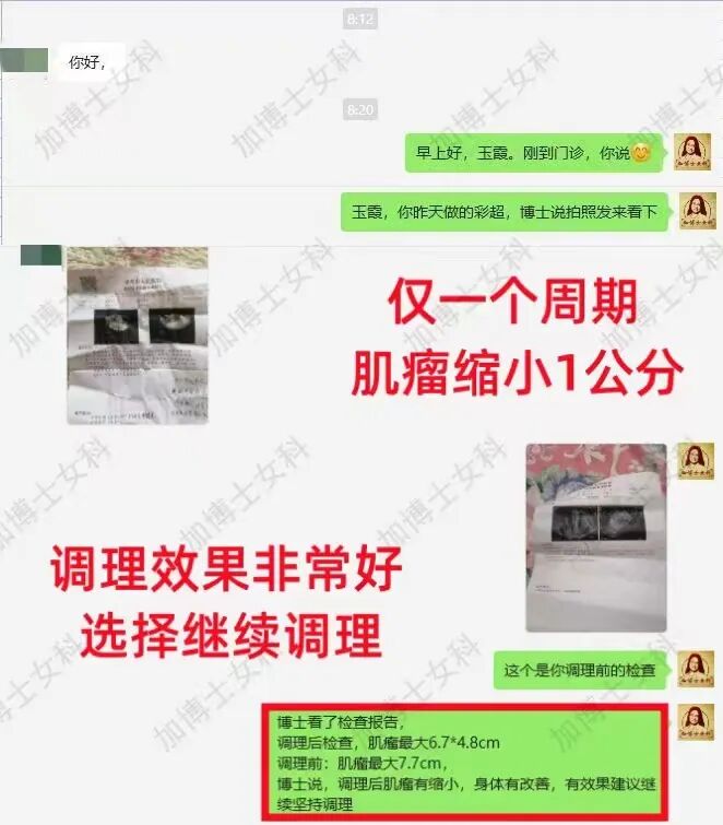 肌瘤钻怎么写术后4年肌瘤再复发，肌瘤竟像爬山虎一样“钻”进了心脏…_https://www.jmylbn.com_新闻资讯_第4张