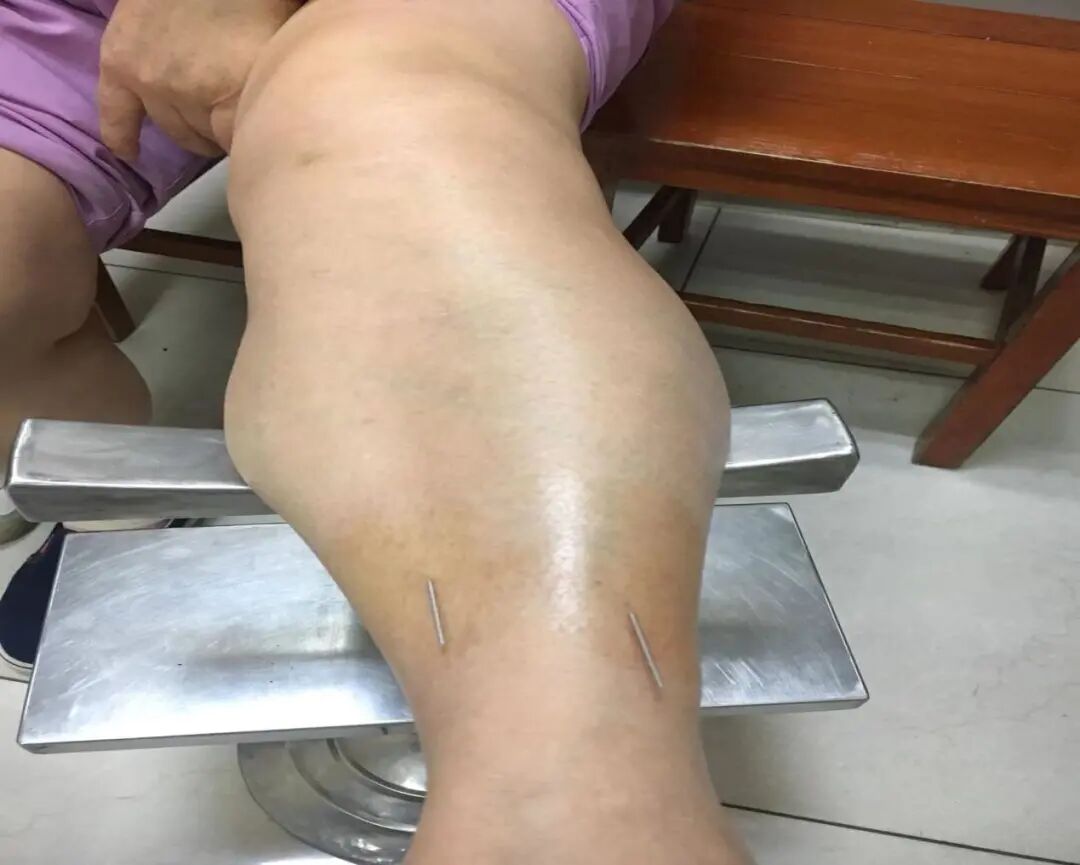 别担心,中医特色针刺疗法腕踝针帮你解决!-友友