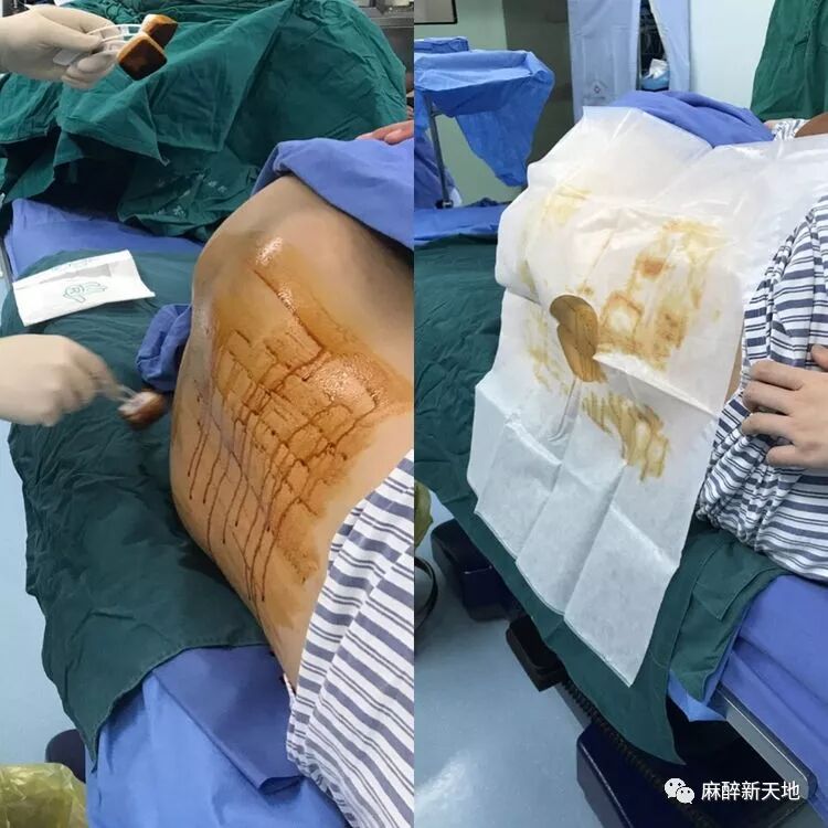 腰麻穿刺无菌敷料包使用操作流程