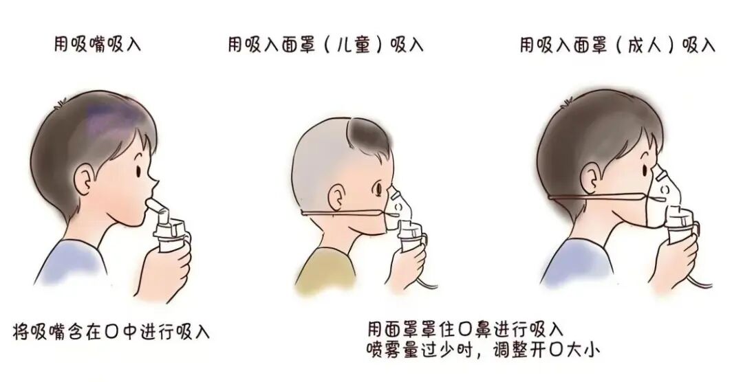 咬嘴雾化怎么呼吸【医生来了】娃娃一到冬天就咳嗽，雾化治疗到底行不行？到底怎么做？来看→_https://www.jmylbn.com_新闻资讯_第4张