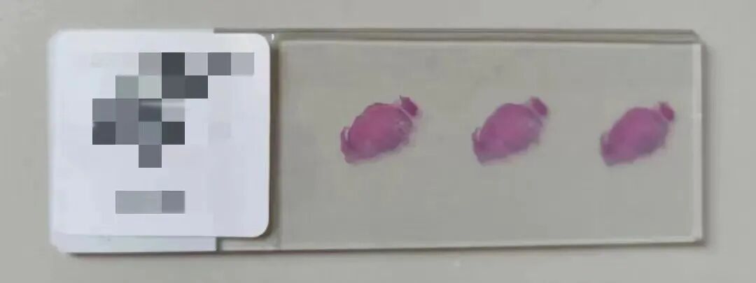 什么是病理蜡块【公卫科普】什么是病理切片、蜡块、白片？_https://www.jmylbn.com_新闻资讯_第26张