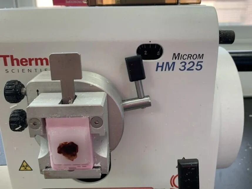 什么是病理蜡块【公卫科普】什么是病理切片、蜡块、白片？_https://www.jmylbn.com_新闻资讯_第21张