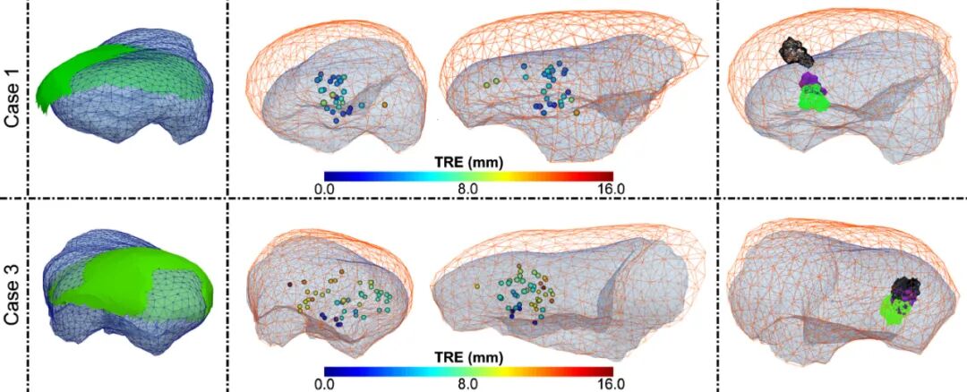 什么是数字肺膨胀肺／萎陷肺的真相：人工气胸下的支气管+肺实质数字模型与三维重建？_https://www.jmylbn.com_新闻资讯_第11张