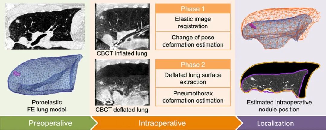 什么是数字肺膨胀肺／萎陷肺的真相：人工气胸下的支气管+肺实质数字模型与三维重建？_https://www.jmylbn.com_新闻资讯_第10张