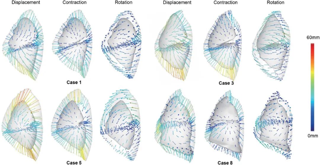 什么是数字肺膨胀肺／萎陷肺的真相：人工气胸下的支气管+肺实质数字模型与三维重建？_https://www.jmylbn.com_新闻资讯_第27张