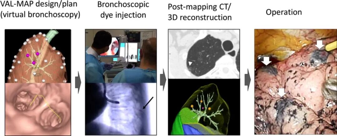 什么是数字肺膨胀肺／萎陷肺的真相：人工气胸下的支气管+肺实质数字模型与三维重建？_https://www.jmylbn.com_新闻资讯_第8张