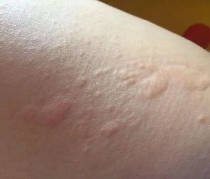 寒冷性荨麻疹怎么治?用桂枝麻黄各半汤!_李志忠_主治医师_爱问健康 寒冷性荨麻疹怎么治?用桂枝麻黄各半汤!_李志忠_主治医师_爱问健康