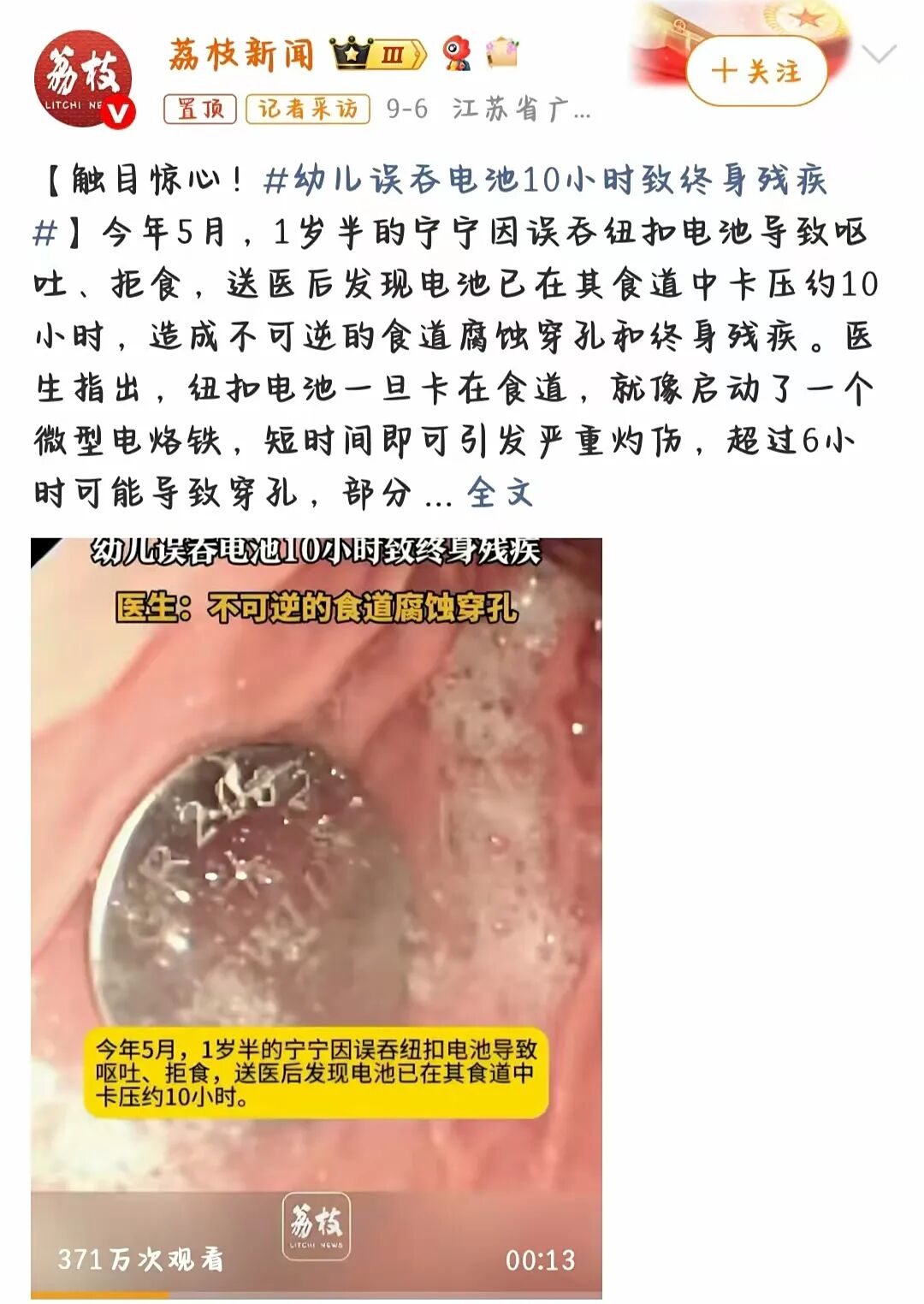 幼儿误吞电池10小时致终身残疾