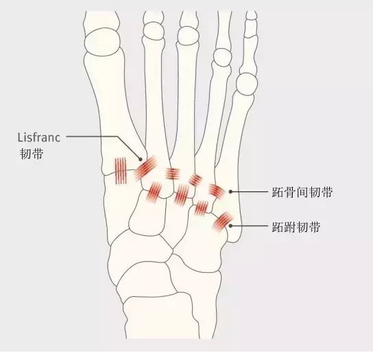 跖跗关节骨折伴脱位的诊治4问答