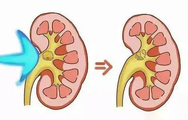 体外碎石b超怎么定位泌尿系统结石患者的福音——我院引进新一代B超定位体外冲击波碎石机_https://www.jmylbn.com_新闻资讯_第1张