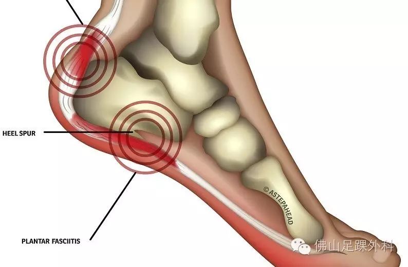 保护足跟避免跟痛症