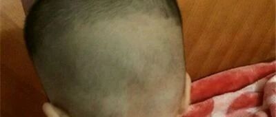 顺产分娩，经过产道挤压，新生宝宝的囟门会提早闭合吗？