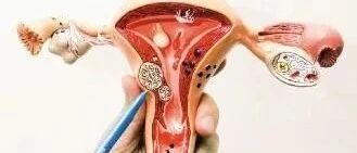 四种子宫肌瘤，一种要手术，两种要观察，还有一种不能大