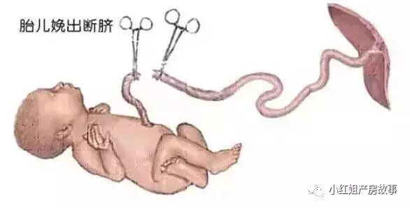 为什么剪脐带要先夹住胎儿出生后多长时间断脐带，30秒，还是2分钟？为什么一定要给婴儿晚断脐？_https://www.jmylbn.com_新闻资讯_第1张