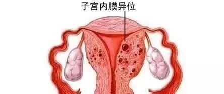 每月来了大姨妈，剖宫产手术刀口肚皮就疼，留神子宫内膜症在做怪