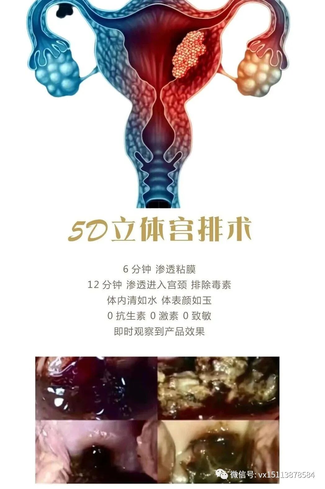 妇科臭氧怎么操作私密宫排臭氧油／臭氧排毒宫排-有那些作用？臭氧宫腔净化，360度宫腔排毒，臭氧宫排如何操作，臭氧油是什么，如何调理妇科炎症？_https://www.jmylbn.com_新闻资讯_第5张