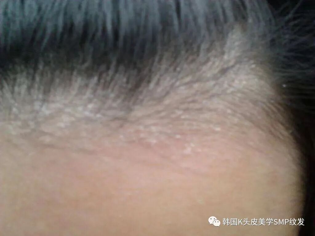 头皮上有白色大片的皮怎么办？