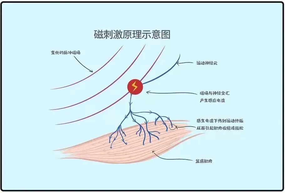 盆底康复治疗仪怎么用【专科介绍】盆底磁疗，不用脱，坐着就可以的“懒人”神器！_https://www.jmylbn.com_新闻资讯_第3张