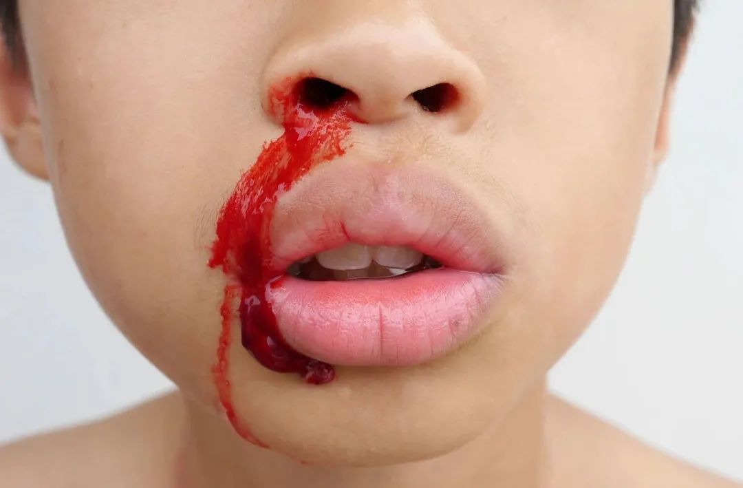 这也给人们敲响了警钟,鼻子流血不要单纯的认为是鼻炎,顽固性流鼻血需