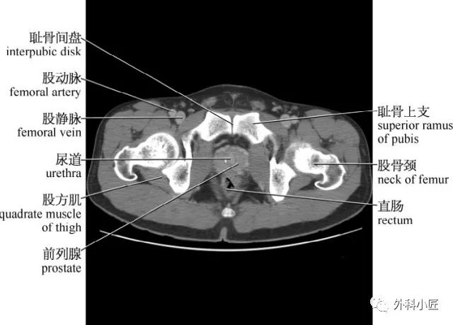 女性盆腔CT图解图片