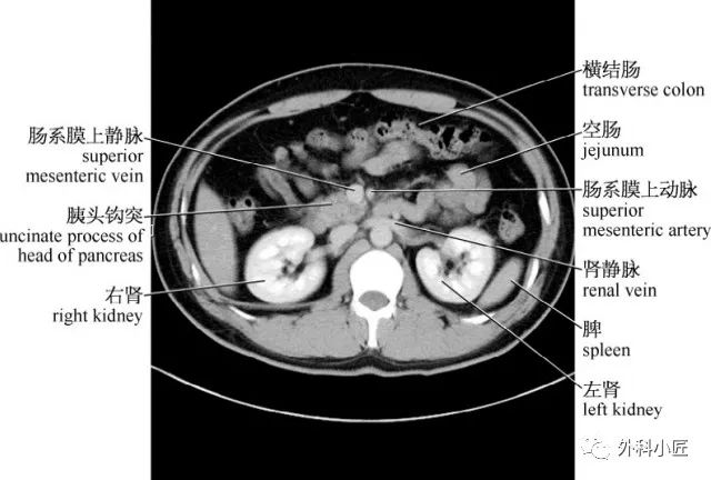 46組對比圖帶你完全掌握腹部影像解剖_醫學界-助力醫生臨床決策和職業