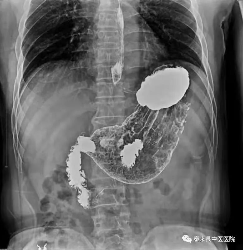 数字胃肠透视怎么做〖医疗篇〗数字化透视、造影、摄影---DRF-4动态大平板数字胃肠机_https://www.jmylbn.com_新闻资讯_第8张