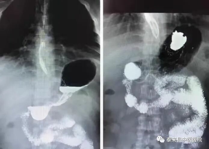 数字胃肠透视怎么做〖医疗篇〗数字化透视、造影、摄影---DRF-4动态大平板数字胃肠机_https://www.jmylbn.com_新闻资讯_第9张