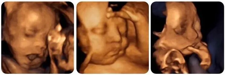 汕头彩超怎么样不再抓瞎！一篇文章带你读懂孕期排畸检查，看完记得收藏 ｜ 汕头妇产科医院_https://www.jmylbn.com_新闻资讯_第13张