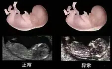 汕头彩超怎么样不再抓瞎！一篇文章带你读懂孕期排畸检查，看完记得收藏 ｜ 汕头妇产科医院_https://www.jmylbn.com_新闻资讯_第10张