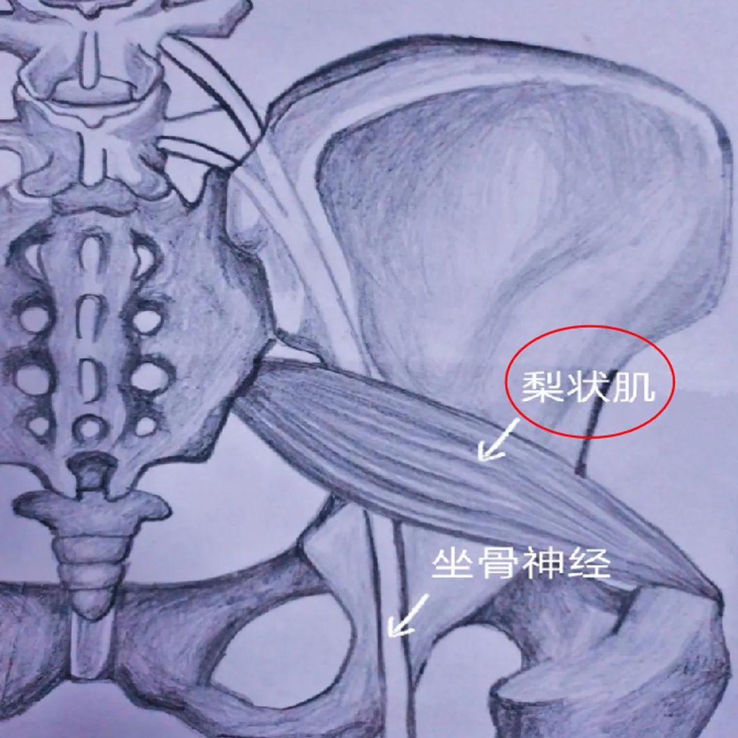 有一种屁股痛叫梨状肌综合症