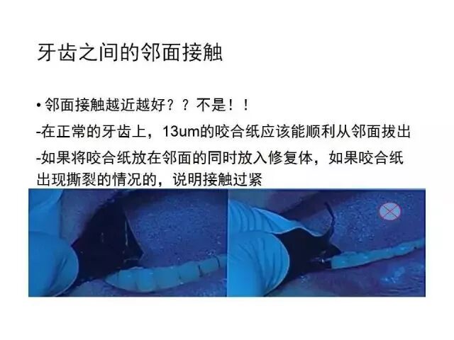 临床上食物嵌塞问题解决方案，高效、实用！