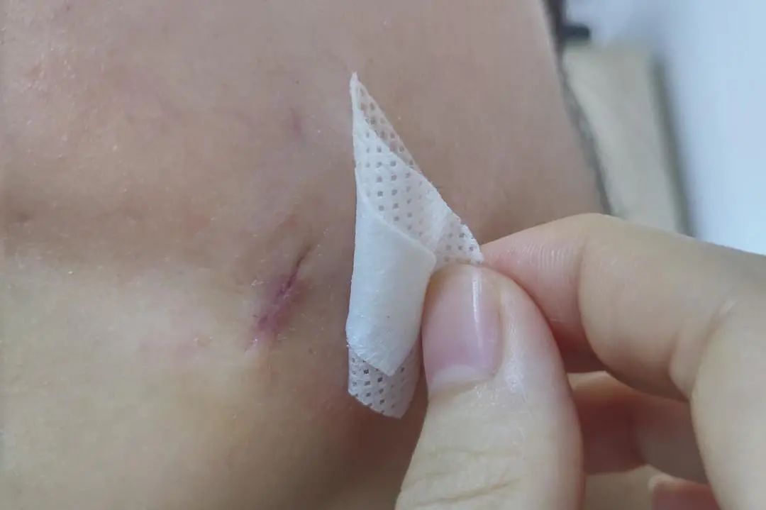 健康科普丨“切痣”术后的保姆级护理教程