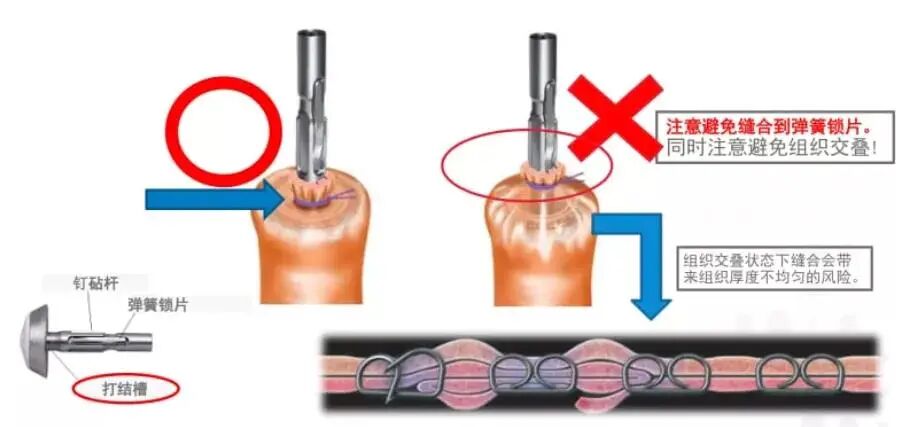 吻合器怎么用柳叶邂逅 ｜ 吻合器专题一：一次性使用管形吻合器操作要点_https://www.jmylbn.com_新闻资讯_第4张